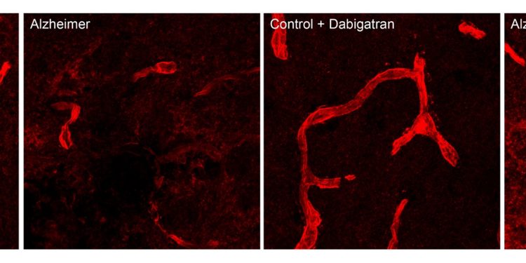 prevención del alzheimer