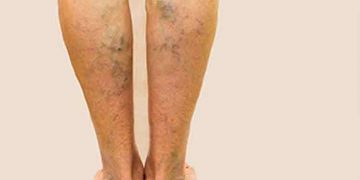 varices