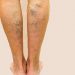 varices